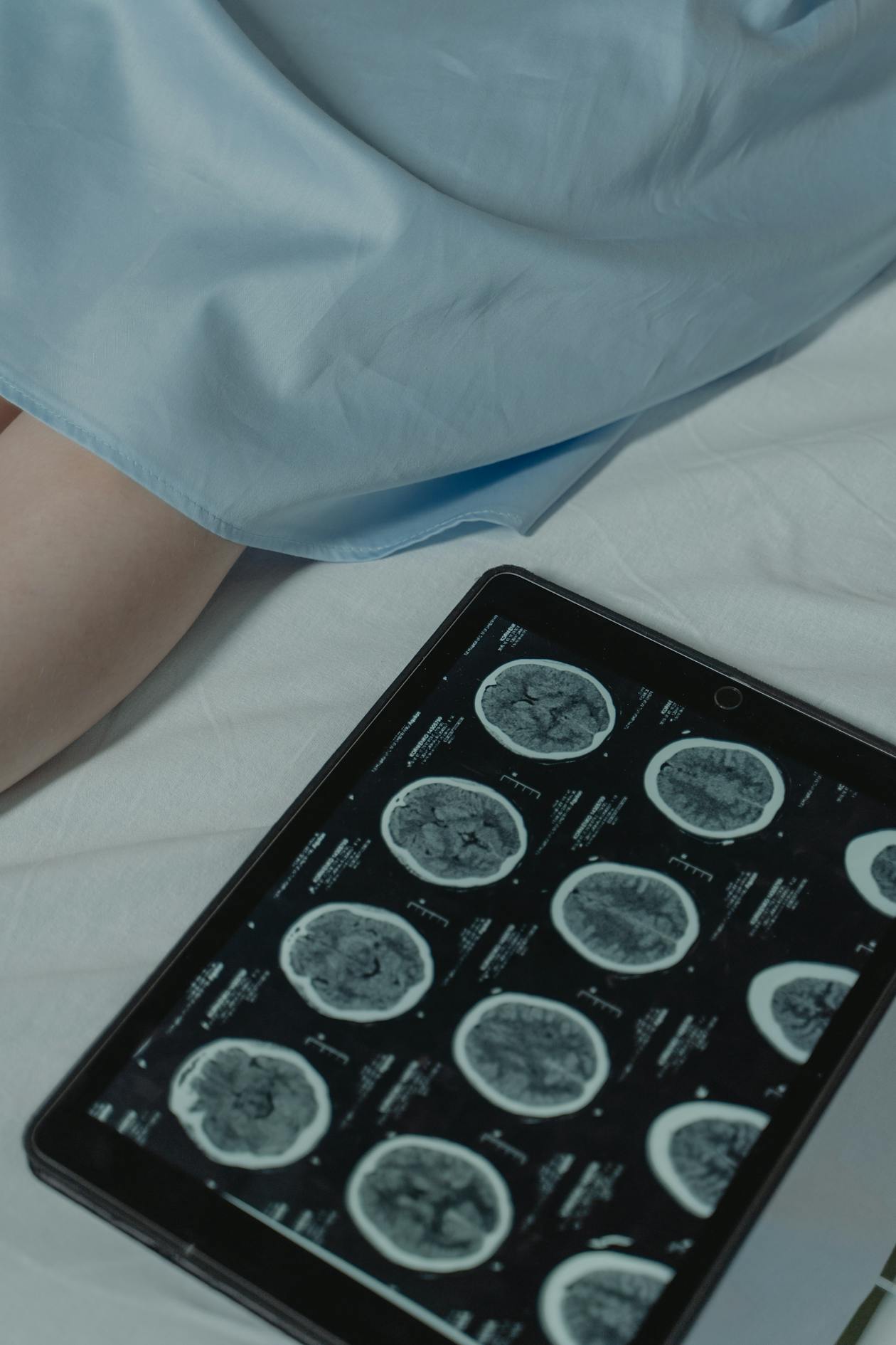 Brain scan monitoring for ARIA - Alzheimer's treatment at home OC